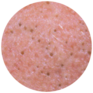 Blackheads
