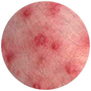 Papules
