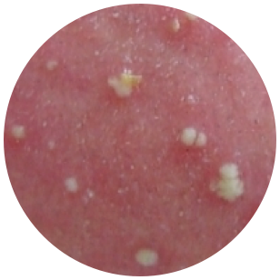 Pustules