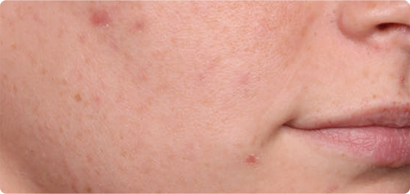Baseline and After Results