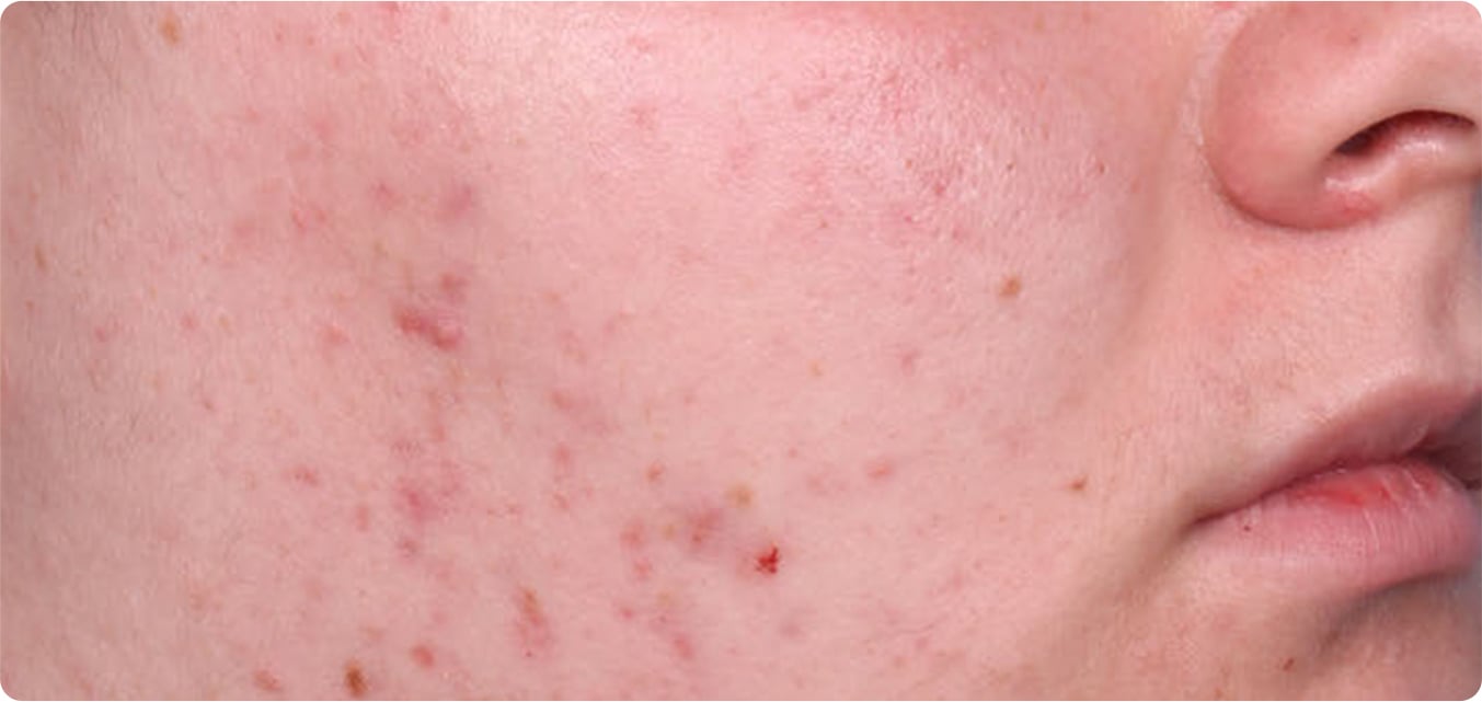 Baseline and After Results
