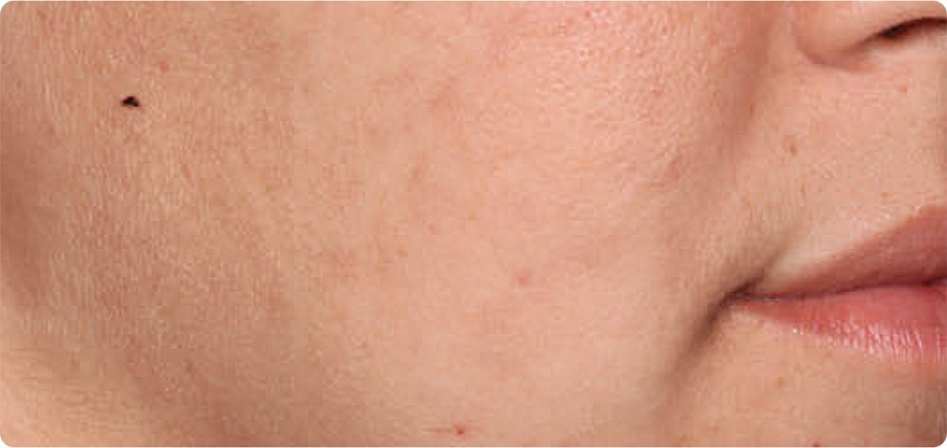 Baseline and After Results