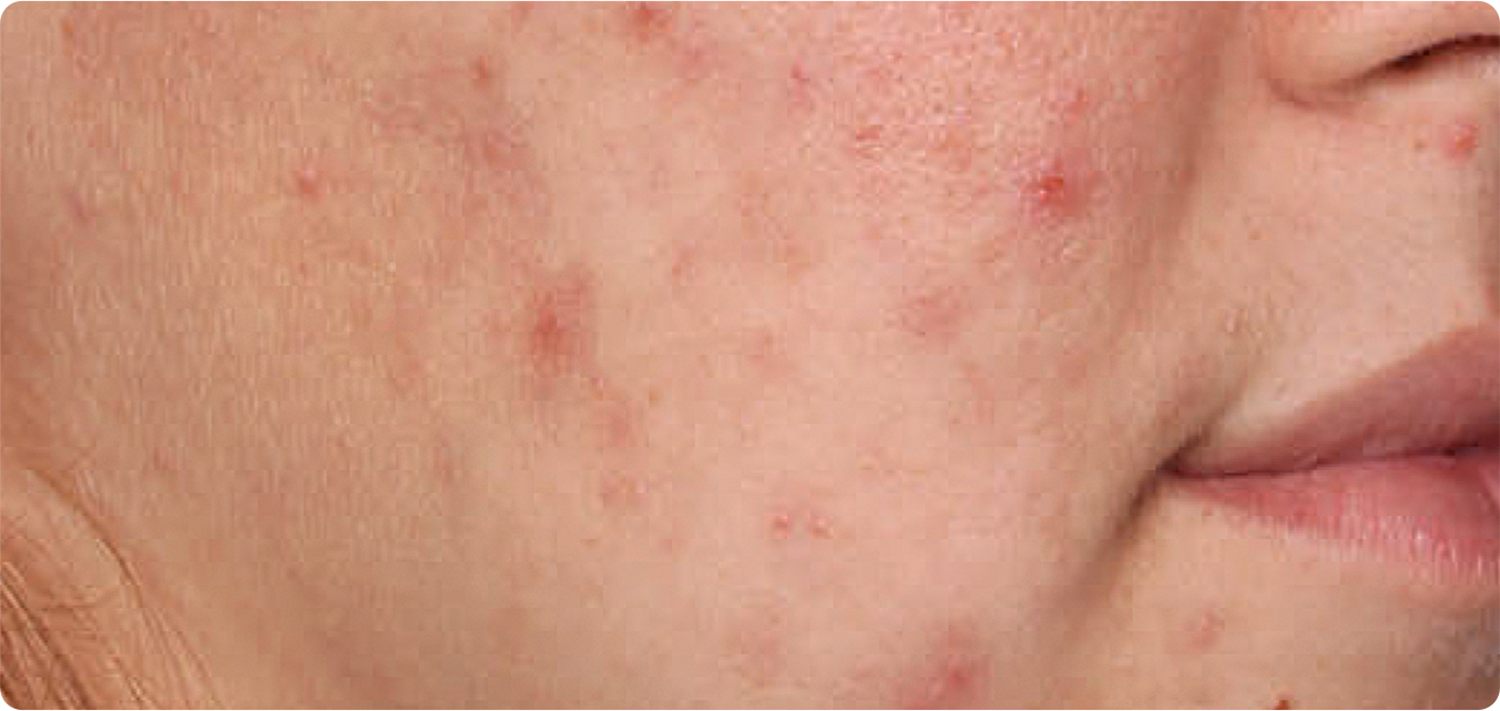 Baseline and After Results